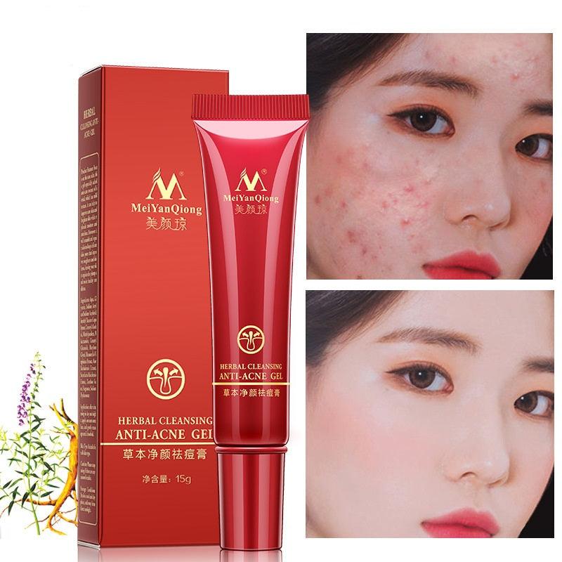 משחה לצלקות אקנה ופצעי בגרות | ג'סטה שופ | Jesta Shop